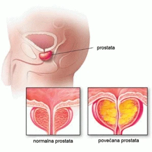 Benigna hiperplazija prostate