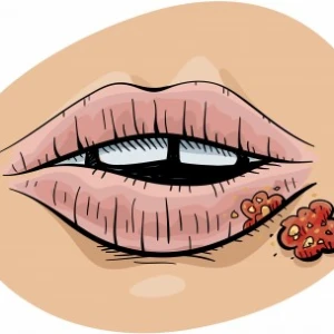 HERPES SIMPLEX
